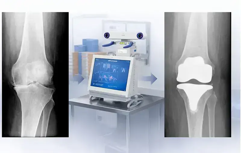 navegacao tem a ver com a cirurgia de protese de joelho Dr. Marcelo Corvino Brasilia