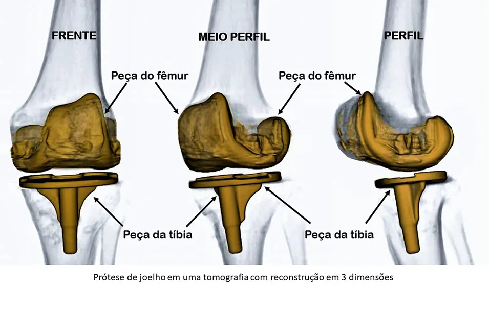 Dr. Marcelo Corvino - Ortopedista - Protese-de-joelho-em-tomografia-reconstruida-em-3D